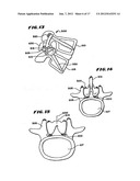 Facet Arthroplasty Devices and Methods diagram and image