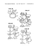 Facet Arthroplasty Devices and Methods diagram and image