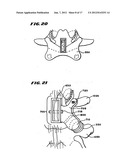 Facet Arthroplasty Devices and Methods diagram and image