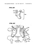 Facet Arthroplasty Devices and Methods diagram and image