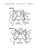 Facet Arthroplasty Devices and Methods diagram and image