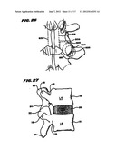 Facet Arthroplasty Devices and Methods diagram and image