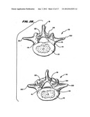 Facet Arthroplasty Devices and Methods diagram and image