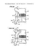 Facet Arthroplasty Devices and Methods diagram and image