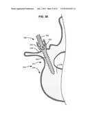 LOW PROFILE SPINAL PROSTHESIS INCORPORATING A CANNULATED BONE ANCHOR     HAVING A DEFLECTABLE POST AND A COMPOUND SPINAL ROD diagram and image