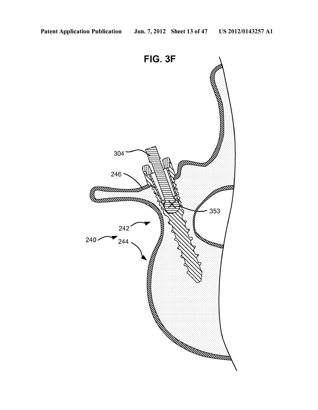 LOW PROFILE SPINAL PROSTHESIS INCORPORATING A CANNULATED BONE ANCHOR     HAVING A DEFLECTABLE POST AND A COMPOUND SPINAL ROD - diagram, schematic, and image 14