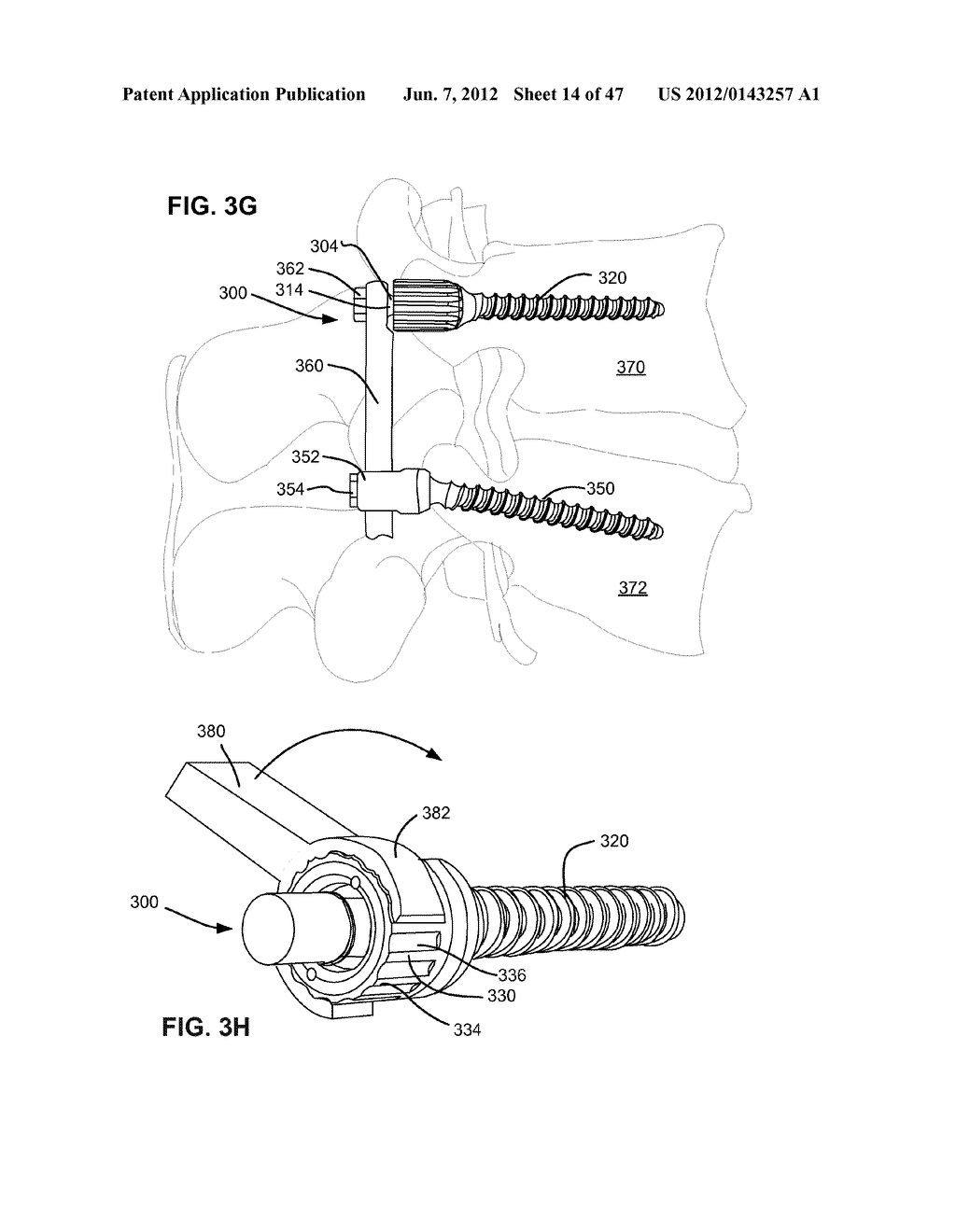 LOW PROFILE SPINAL PROSTHESIS INCORPORATING A CANNULATED BONE ANCHOR     HAVING A DEFLECTABLE POST AND A COMPOUND SPINAL ROD - diagram, schematic, and image 15