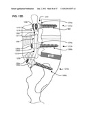 LOW PROFILE SPINAL PROSTHESIS INCORPORATING A CANNULATED BONE ANCHOR     HAVING A DEFLECTABLE POST AND A COMPOUND SPINAL ROD diagram and image