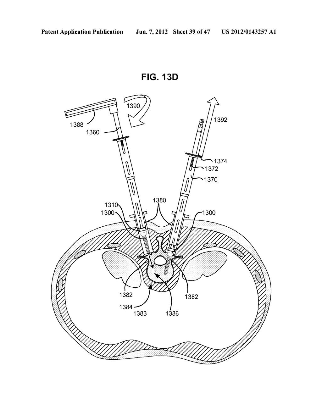 LOW PROFILE SPINAL PROSTHESIS INCORPORATING A CANNULATED BONE ANCHOR     HAVING A DEFLECTABLE POST AND A COMPOUND SPINAL ROD - diagram, schematic, and image 40