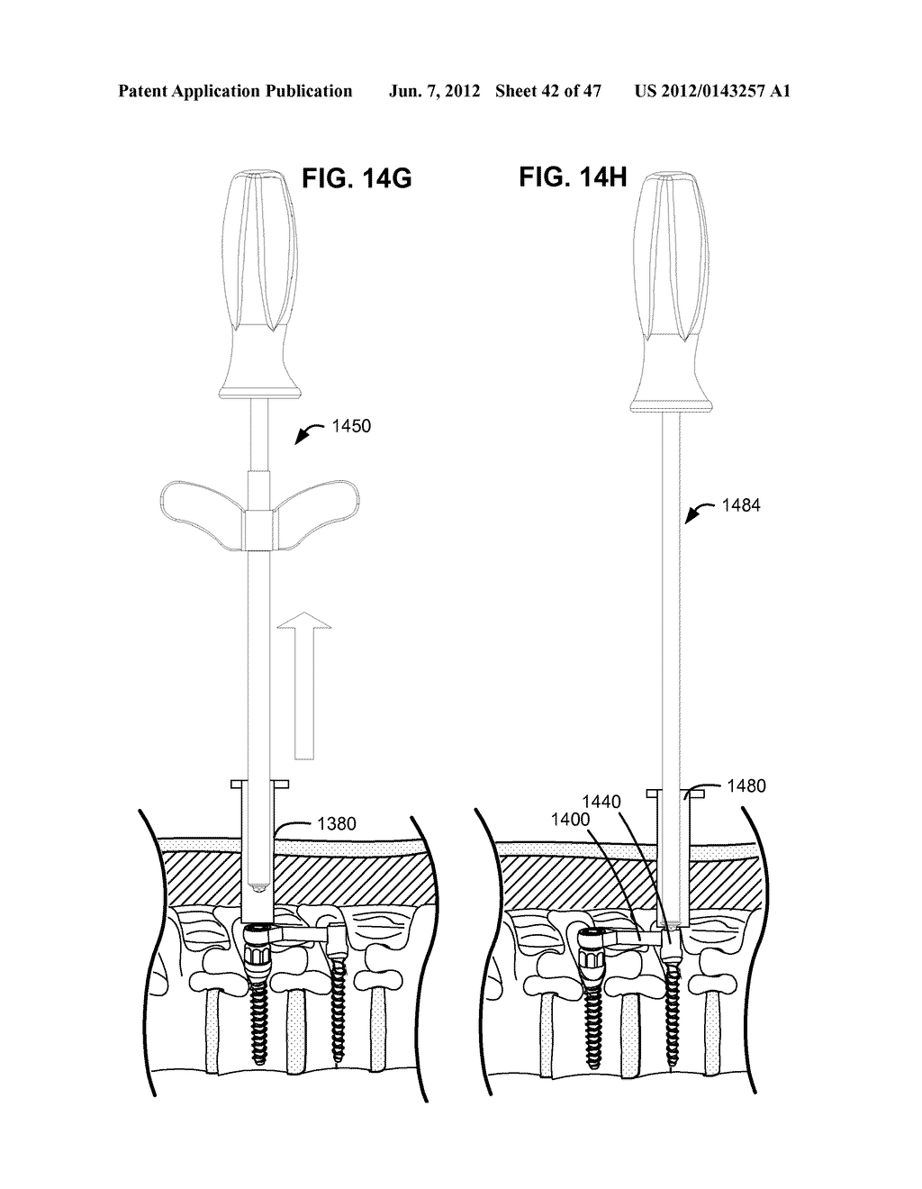 LOW PROFILE SPINAL PROSTHESIS INCORPORATING A CANNULATED BONE ANCHOR     HAVING A DEFLECTABLE POST AND A COMPOUND SPINAL ROD - diagram, schematic, and image 43