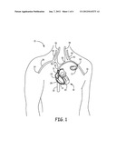 IMPLANTABLE LEAD INCLUDING A SPARK GAP TO REDUCE HEATING IN MRI     ENVIRONMENTS diagram and image