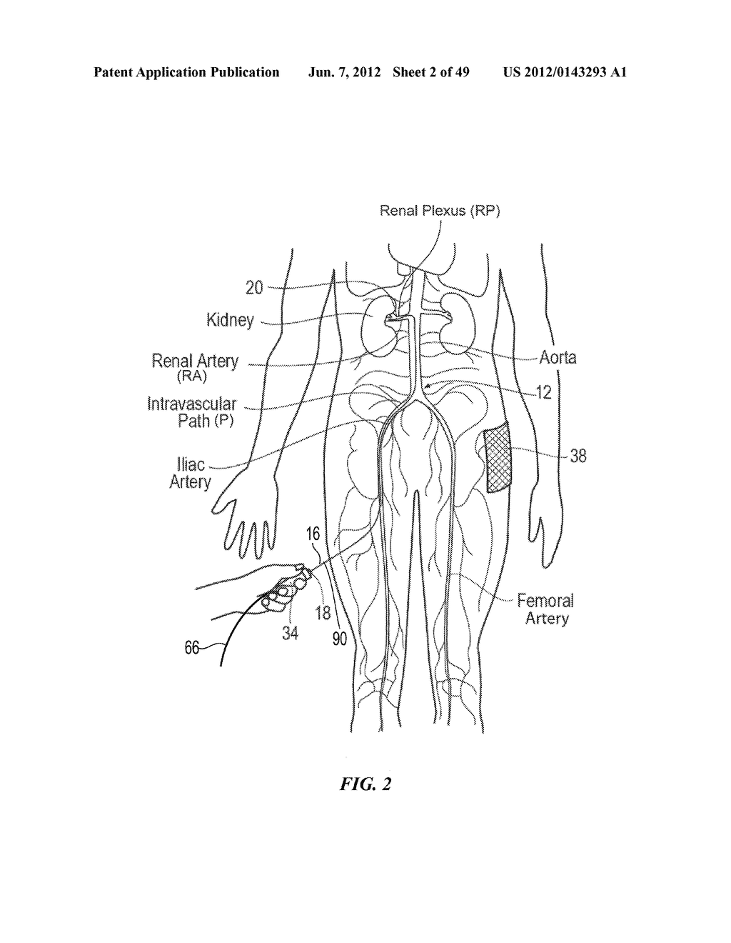 CATHETER APPARATUSES HAVING MULTI-ELECTRODE ARRAYS FOR RENAL     NEUROMODULATION AND ASSOCIATED SYSTEMS AND METHODS - diagram, schematic, and image 03