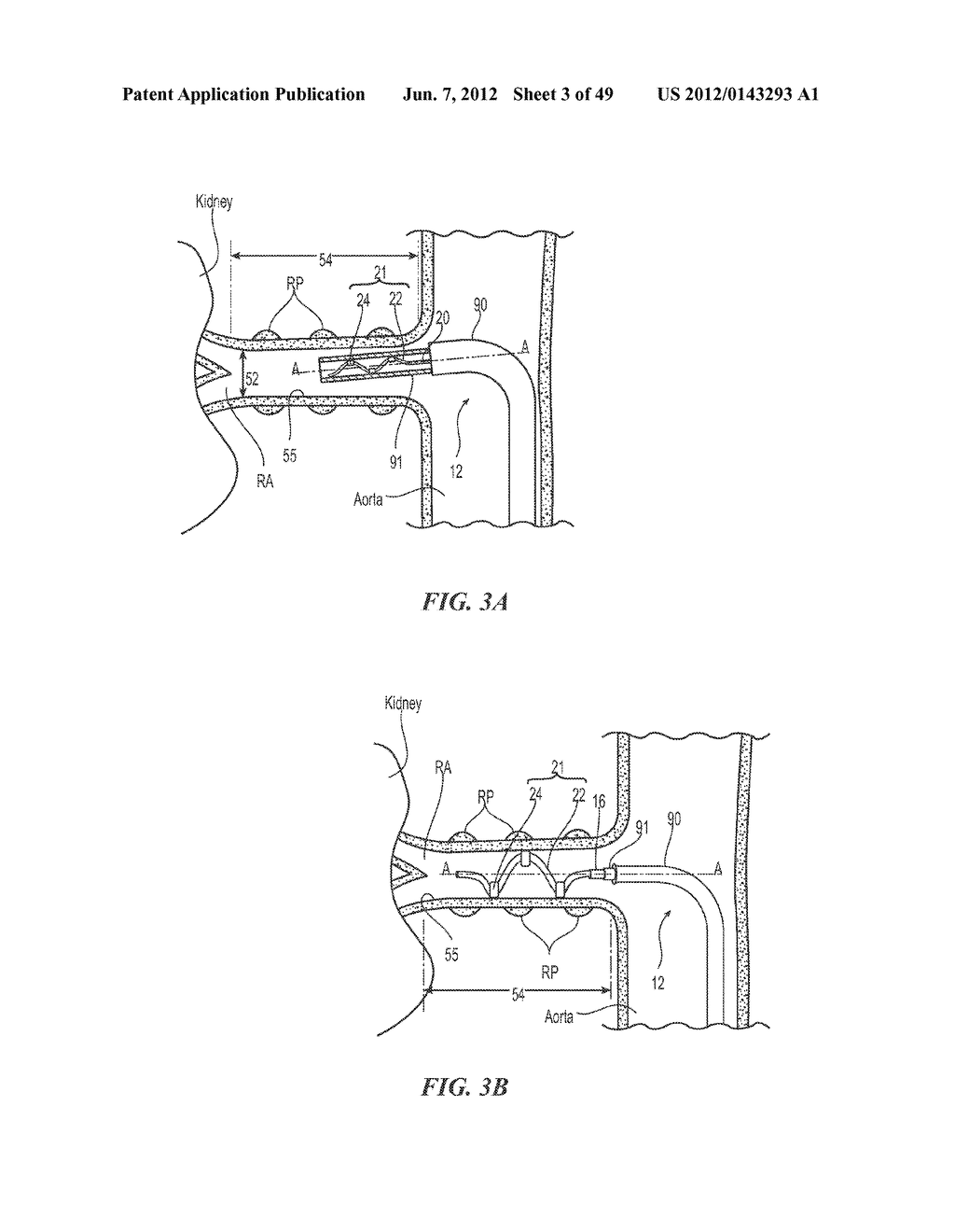 CATHETER APPARATUSES HAVING MULTI-ELECTRODE ARRAYS FOR RENAL     NEUROMODULATION AND ASSOCIATED SYSTEMS AND METHODS - diagram, schematic, and image 04