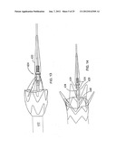 VASCULAR REPAIR DEVICES diagram and image