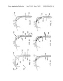 VASCULAR REPAIR DEVICES diagram and image