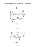 Aortic Valve Devices diagram and image