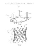 Aortic Valve Devices diagram and image