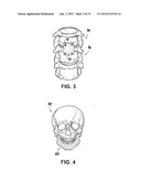 SHAPED LOAD-BEARING OSTEOIMPLANT AND METHODS OF MAKING THE SAME diagram and image