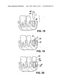 SHAPED LOAD-BEARING OSTEOIMPLANT AND METHODS OF MAKING THE SAME diagram and image