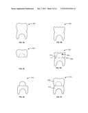 SYSTEMS, METHODS, APPARATUSES, AND COMPUTER-READABLE STORAGE MEDIA FOR     DESIGNING AND MANUFACTURING CUSTOM DENTAL PREPARATION GUIDES diagram and image