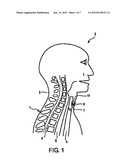 TRACHEOSTOMA SPACER, TRACHEOTOMY METHOD, AND DEVICE FOR INSERTING A     TRACHEOSTOMA SPACER diagram and image