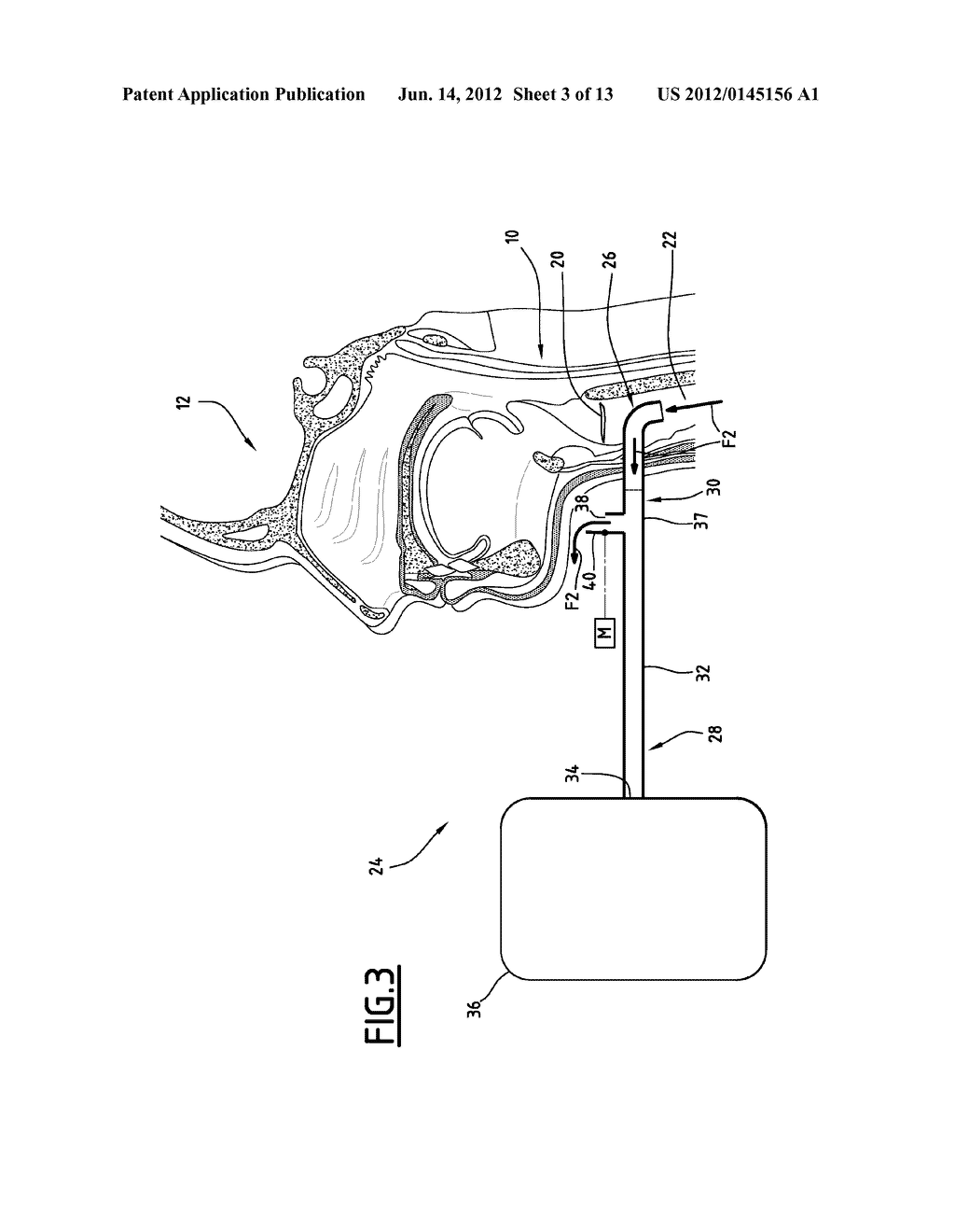PHONATION ASSISTANCE DEVICE FOR A TRACHEOTOMY PATIENT - diagram, schematic, and image 04