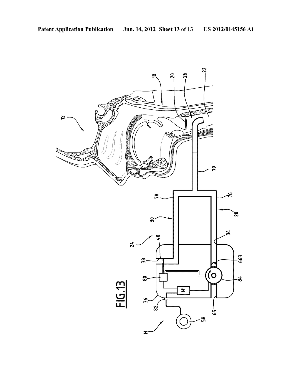 PHONATION ASSISTANCE DEVICE FOR A TRACHEOTOMY PATIENT - diagram, schematic, and image 14