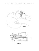 Intra-oral mandibular advancement appliance diagram and image