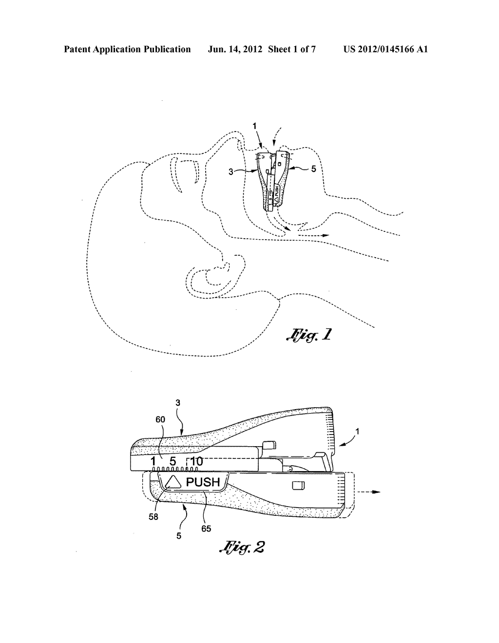 Intra-oral mandibular advancement appliance - diagram, schematic, and image 02