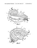 Intra-oral mandibular advancement appliance diagram and image