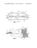 Intra-oral mandibular advancement appliance diagram and image