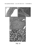 PREVENTION OF INFARCT EXPANSION diagram and image