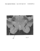 IMPLANTABLE DEVICES FOR THE TREATMENT OF INCONTINENCE AND METHODS OF USING     SAME diagram and image