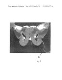 IMPLANTABLE DEVICES FOR THE TREATMENT OF INCONTINENCE AND METHODS OF USING     SAME diagram and image