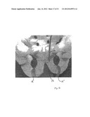 IMPLANTABLE DEVICES FOR THE TREATMENT OF INCONTINENCE AND METHODS OF USING     SAME diagram and image