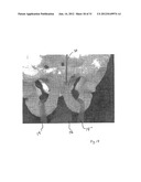 IMPLANTABLE DEVICES FOR THE TREATMENT OF INCONTINENCE AND METHODS OF USING     SAME diagram and image