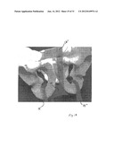 IMPLANTABLE DEVICES FOR THE TREATMENT OF INCONTINENCE AND METHODS OF USING     SAME diagram and image