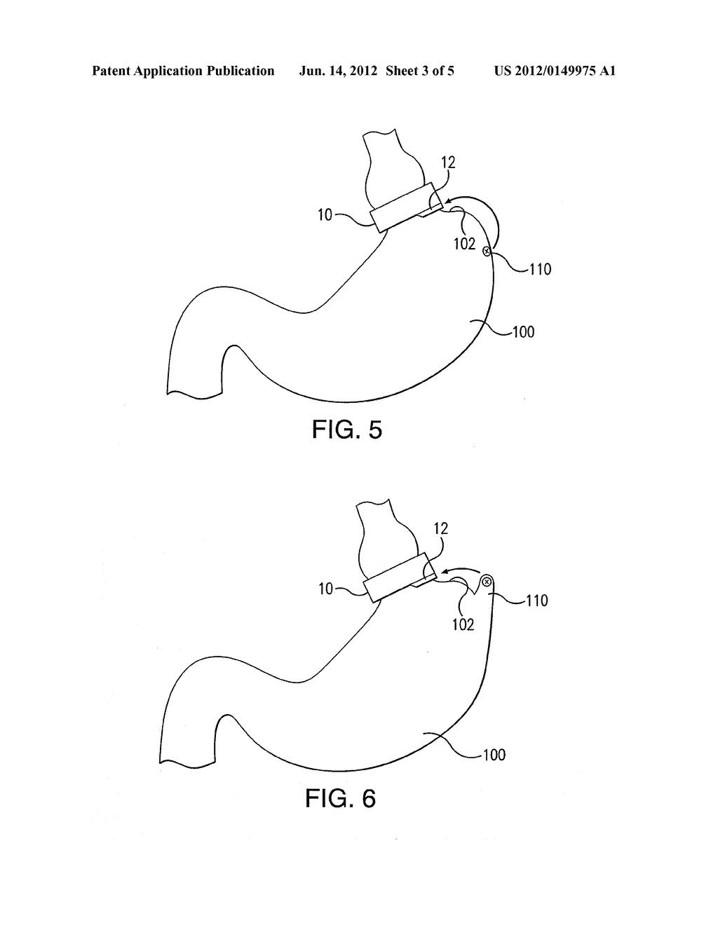 LAPAROSCOPIC ADJUSTABLE GASTRIC BAND - diagram, schematic, and image 04