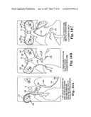 SURGICAL ARTICLES AND METHODS diagram and image