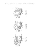 PELVIC IMPLANT WITH SUSPENDING SYSTEM diagram and image