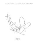 PELVIC IMPLANT WITH SUSPENDING SYSTEM diagram and image