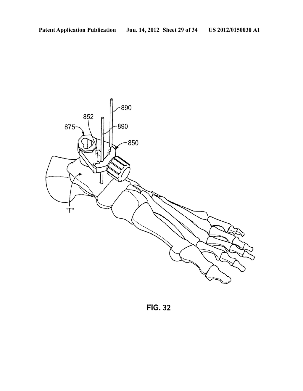 Instruments, Methods and Systems for Harvesting and Implanting Cartilage     Material - diagram, schematic, and image 30