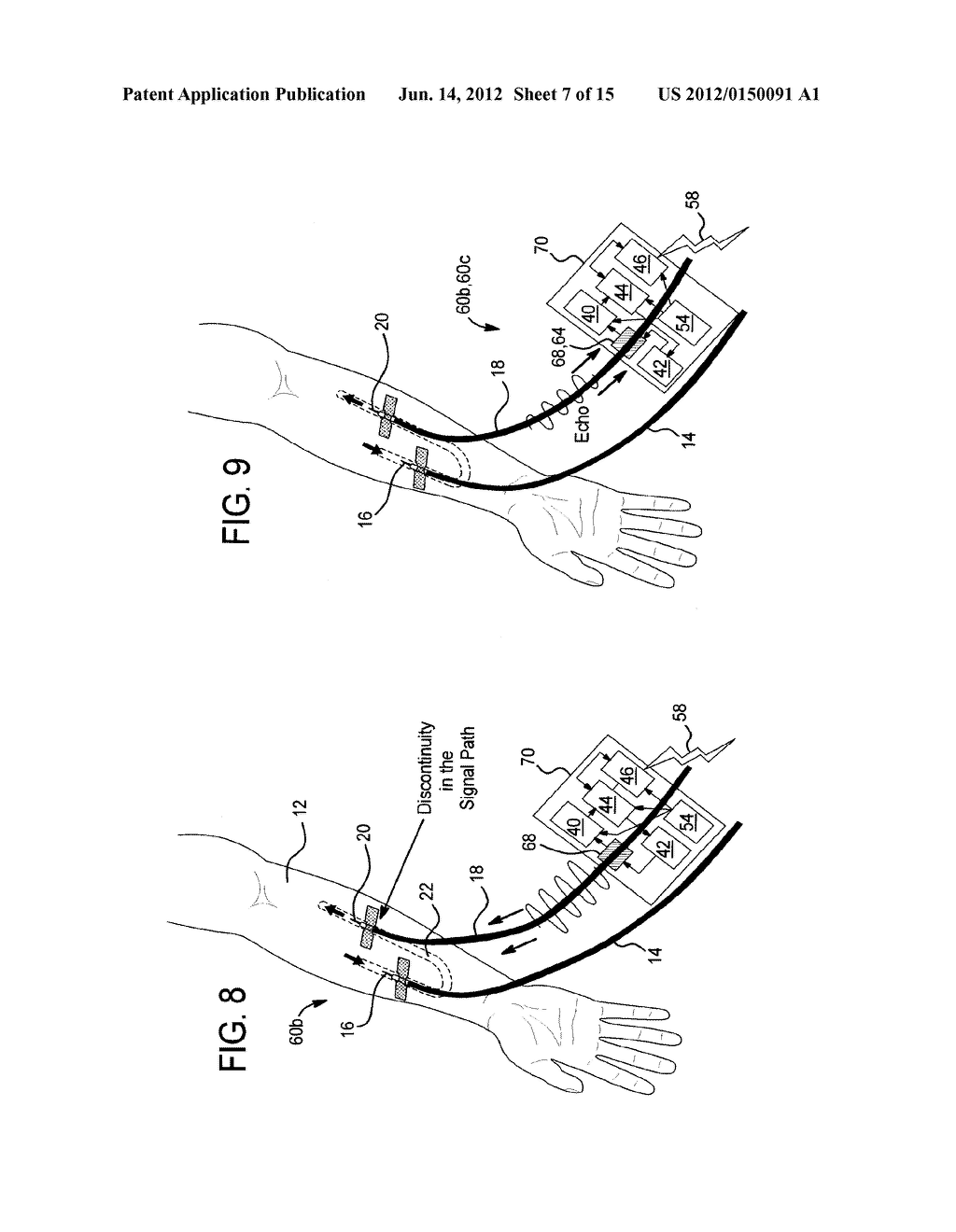 ACOUSTIC ACCESS DISCONNECTION SYSTEMS AND METHODS - diagram, schematic, and image 08