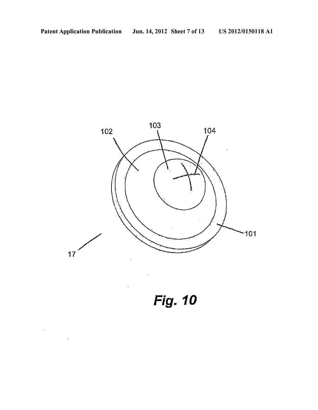 Apparatus for Peripheral Vascular Access - diagram, schematic, and image 08