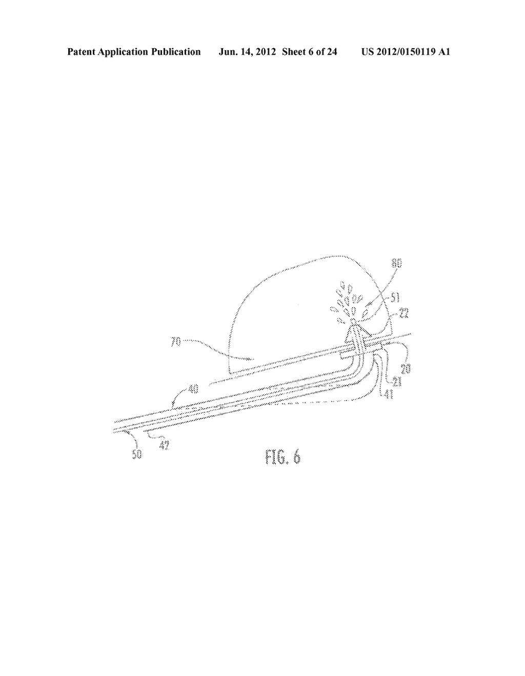 Delivery System for Implanting Nasal Ventilation Tube - diagram, schematic, and image 07