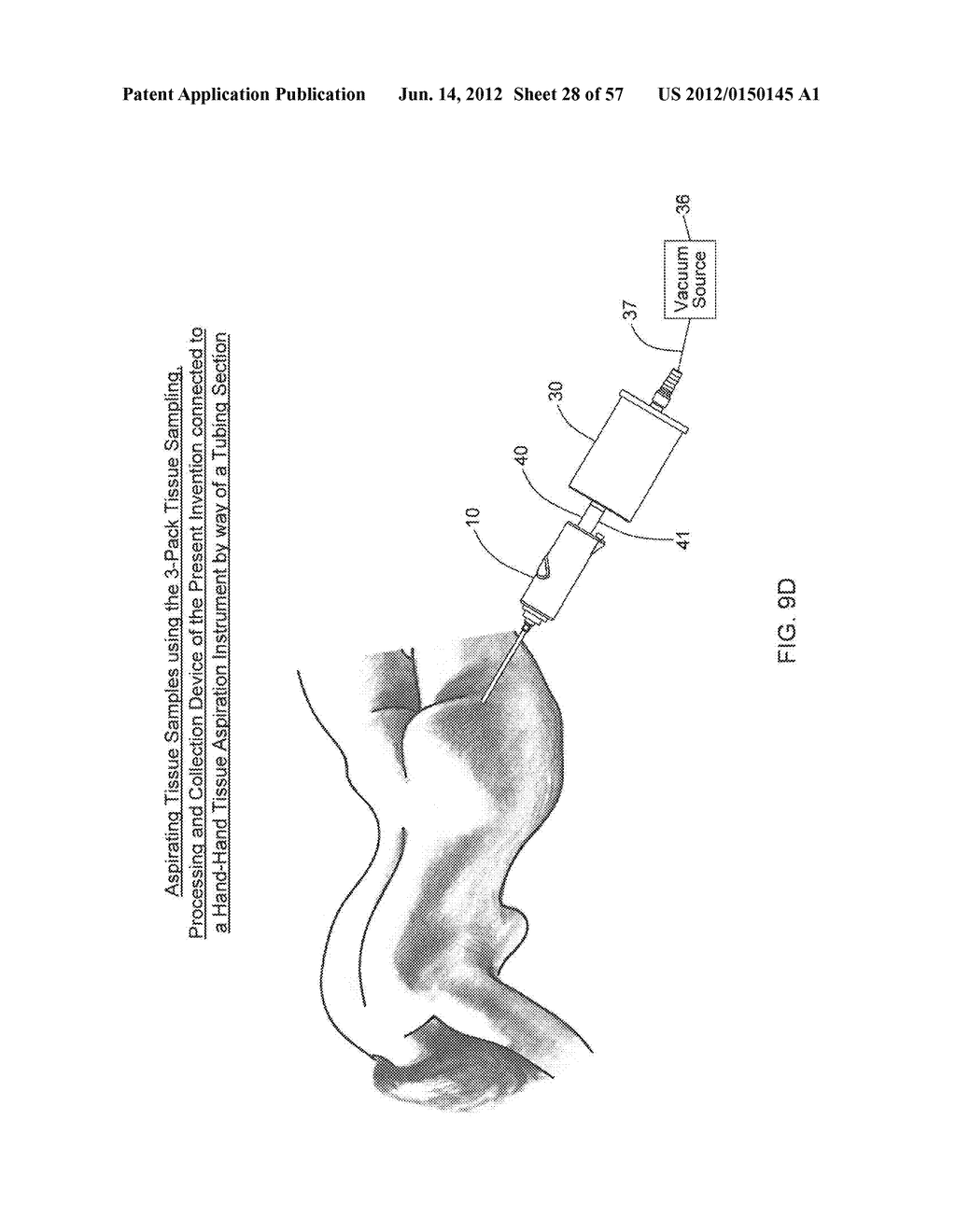 METHODS OF TISSUE SAMPLING, COLLECTION, PROCESSING AND RE-INJECTION USING     MODULAR, DISPOSABLE TISSUE ASPIRATION, PROCESSING, COLLECTION AND/OR     RE-INJECTION COMPONENTS - diagram, schematic, and image 29