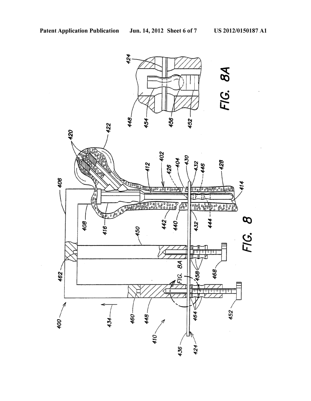 APPARATUS FOR TREATING A FRACTURED BONE - diagram, schematic, and image 07