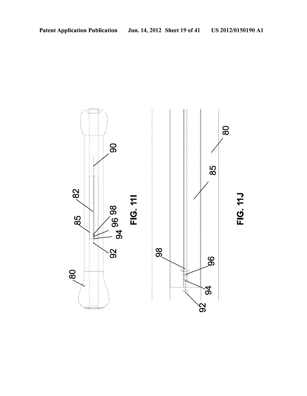 Systems and Methods for Implant Removal - diagram, schematic, and image 20