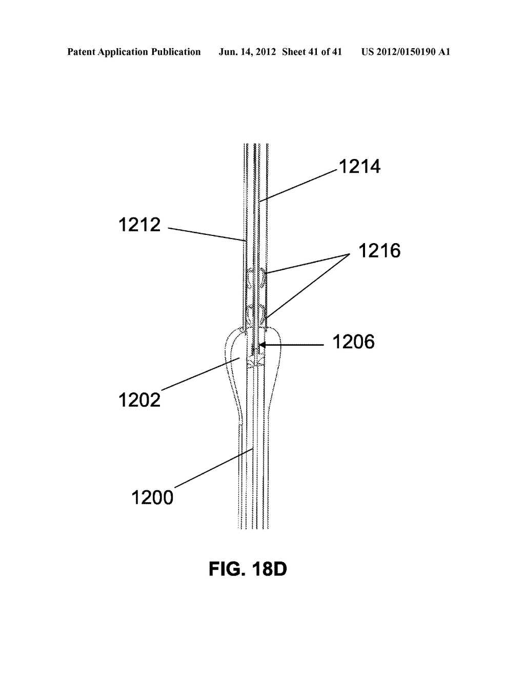 Systems and Methods for Implant Removal - diagram, schematic, and image 42