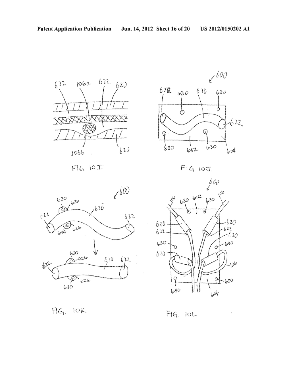 DEVICES CONTAINING A SUTURE SLEEVE AND METHODS OF MAKING AND USING - diagram, schematic, and image 17